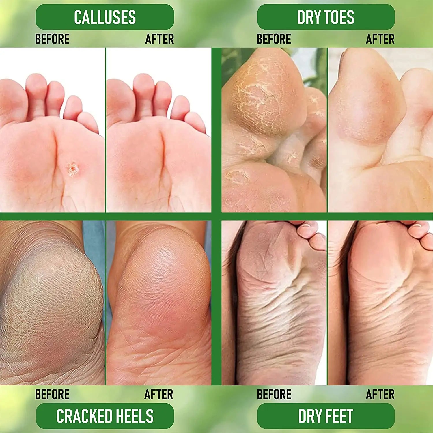 OEM Hand Foot Care Moisturizing Nourishing Removal Callus Peel Crack 2% Salicylic Acid Urea 40% Cream